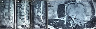 Isolated cryptococcosis of a lumbar vertebra in an immunocompetent patient: A case report and literature review